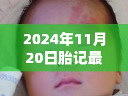 最新胎記治療方法全面步驟指南（2024年11月版）